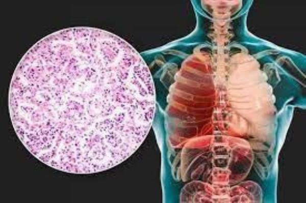 Demuestra vacuna Quimi-Vio su eficacia en la salud infantil