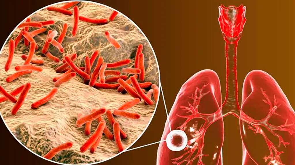Cuba continúa fortaleciendo su lucha contra la tuberculosis